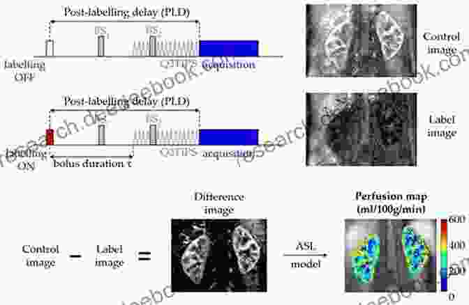 Arterial Spin Labeling (ASL) Scan Brain Mapping: Indications And Techniques