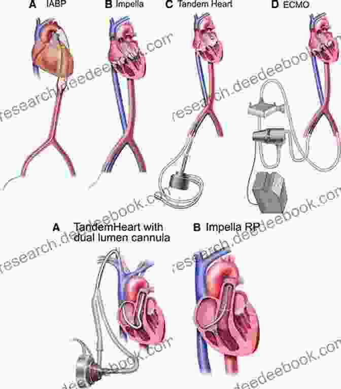 Impella Heart Pump Mechanical Circulatory Support In End Stage Heart Failure: A Practical Manual