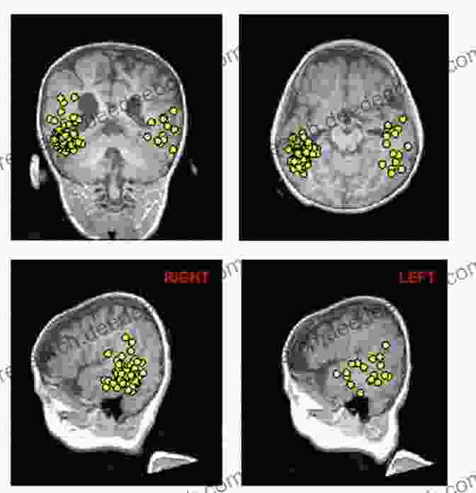Magnetoencephalography (MEG) Scan Brain Mapping: Indications And Techniques