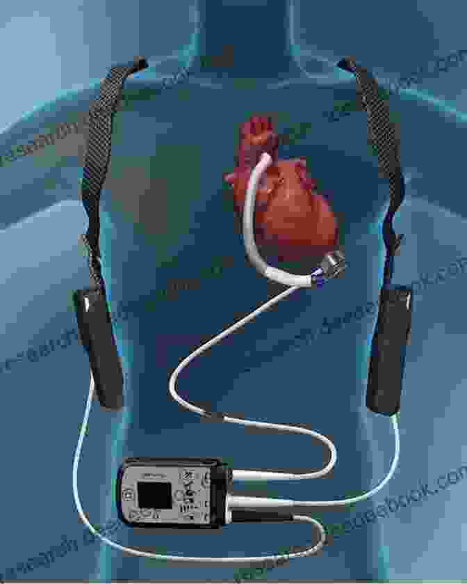 Ventricular Assist Device (VAD) Mechanical Circulatory Support In End Stage Heart Failure: A Practical Manual